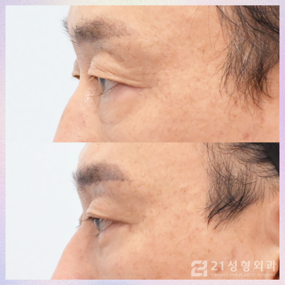 중년눈수술, 젊어지기 위해 필요한 것은 이것입니다 관련 이미지 2