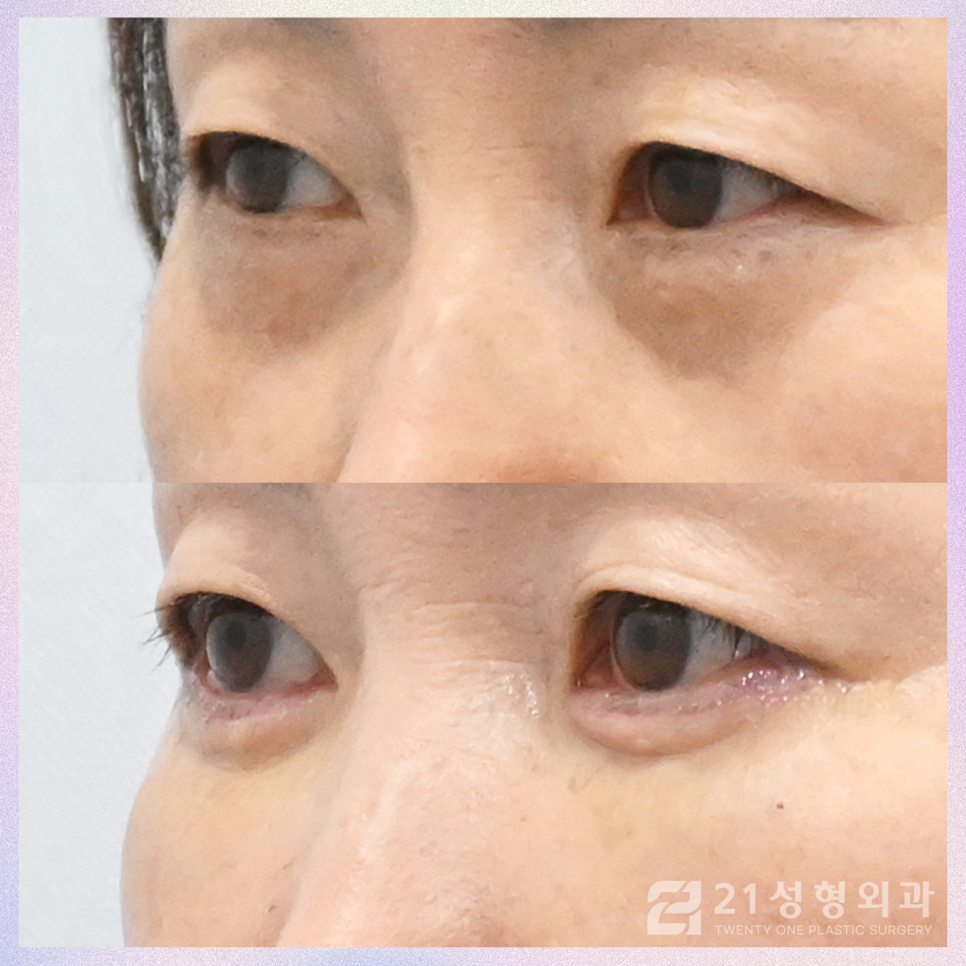 하안검수술후케어 젊음을 유지하기 위해서는 관련 이미지 2