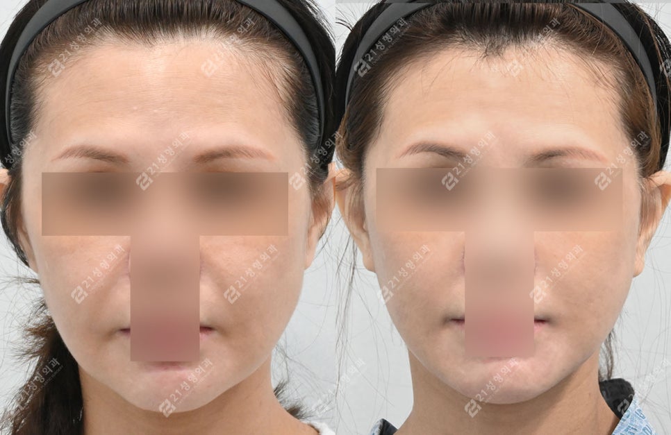 Face and Neck Lift: What Matters More Than Scars Is the Surgical Design image 1