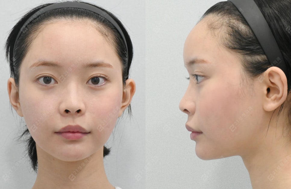 Facial Contouring, Key Points You Must Know: A Real Review of Changes Over 1 Year and 6 Months image 5