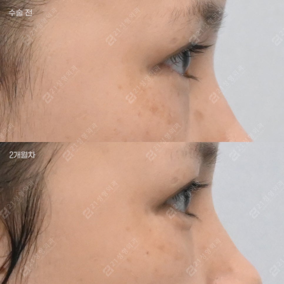 눈밑지방, 무조건 빼면 안 되는 이유 &ndash; 21성형외과 관련 이미지 6