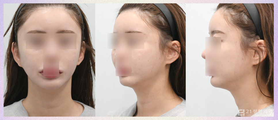 이중턱재수술은 근육묶기로 완성하자 관련 이미지 6