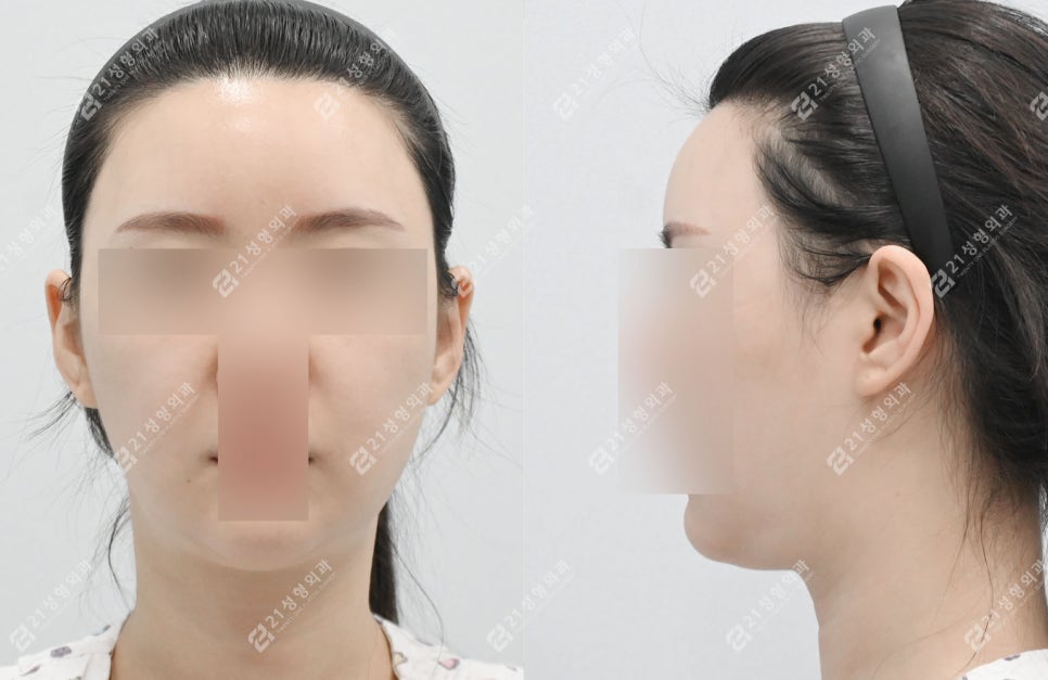 이중턱 수술 후 딱딱함&middot;울퉁불퉁 피부, 괜찮은걸까? 관련 이미지 2