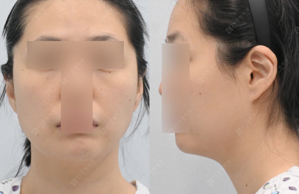 Is simple liposuction enough for double chin surgery? image 3