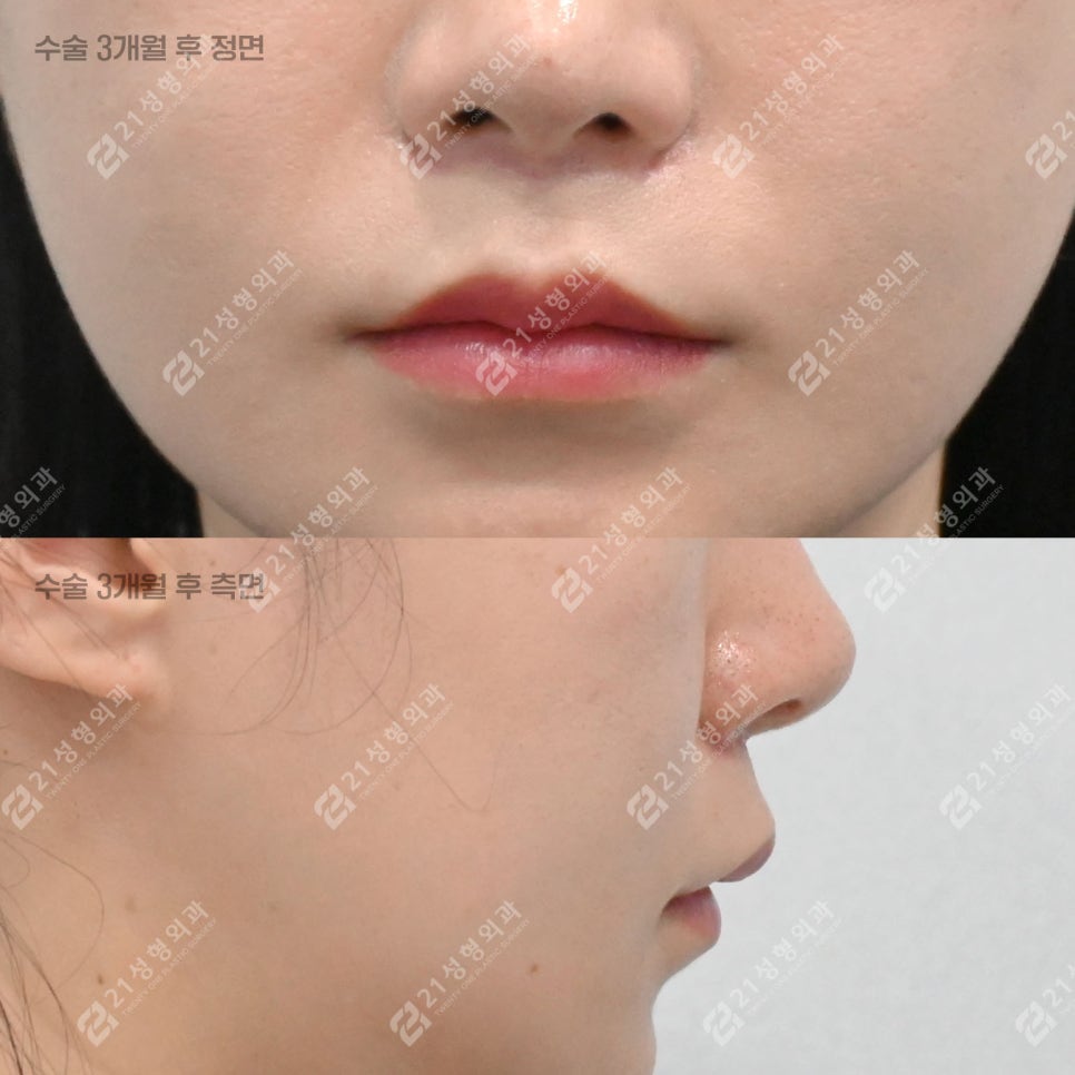 Lip Lift Review | What Matters More Than Length Is Facial Proportion! image 5