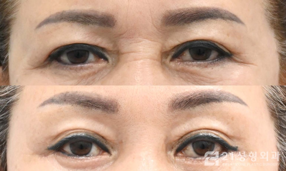 상안검수술흉터 안 보이게 하려면 관련 이미지 1