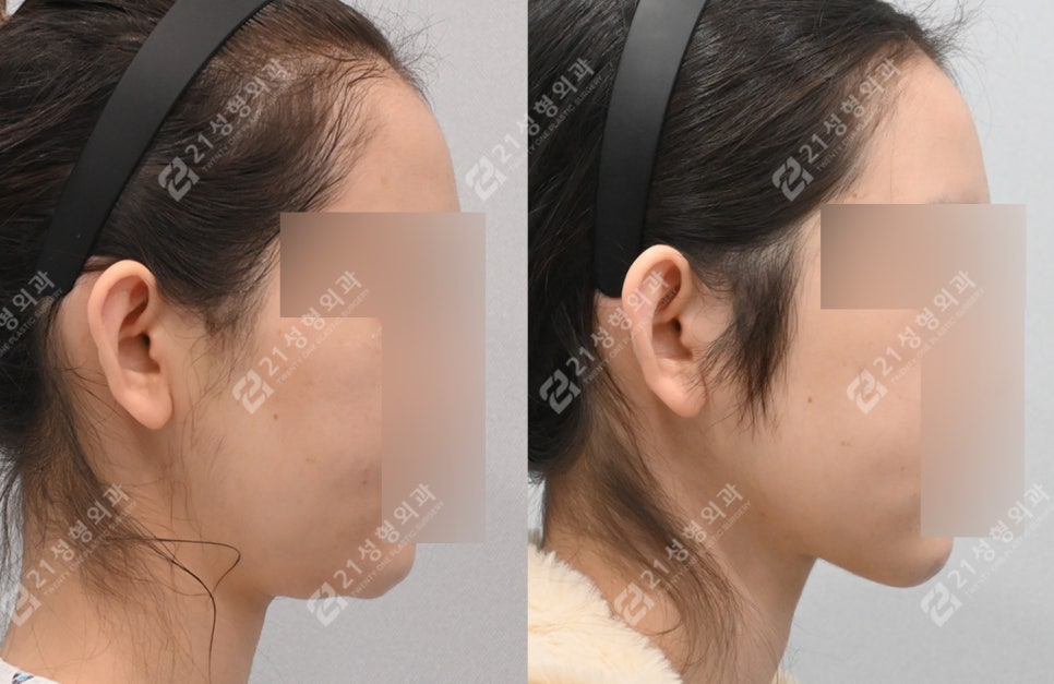 이중턱 수술 후 턱밑 피부가 접혔는데 이게 정상이라고요? 관련 이미지 1
