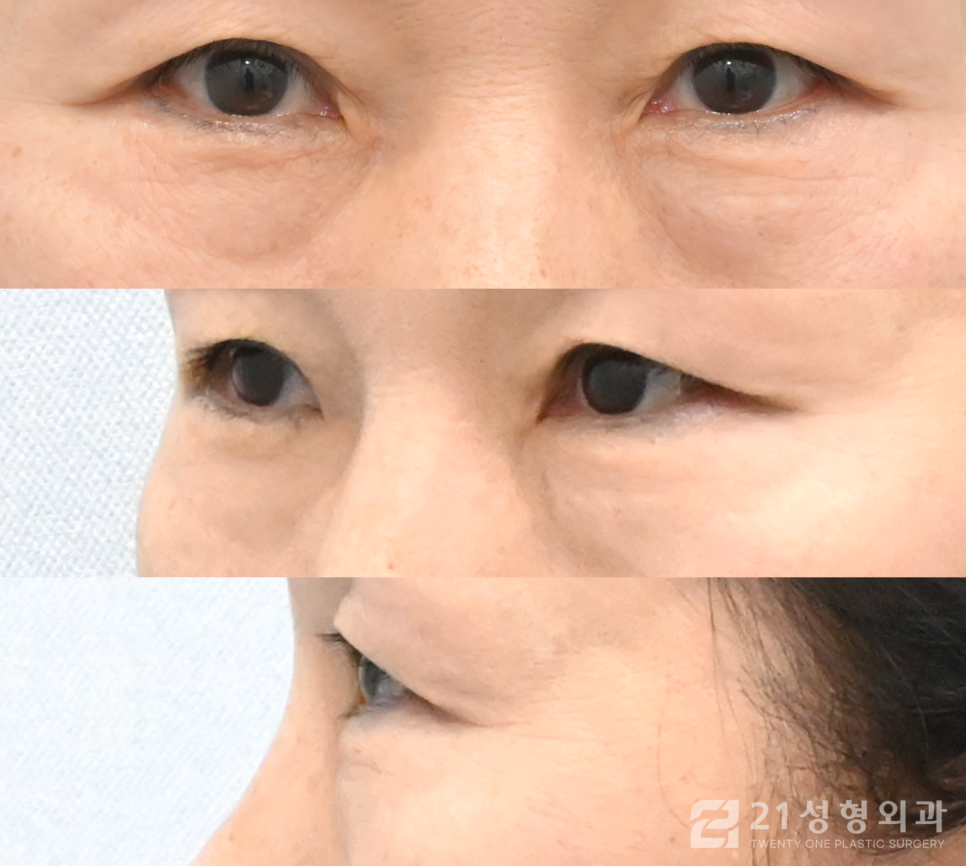 강남하안검수술 생기있는 눈매로 개선하는 방법 관련 이미지 4