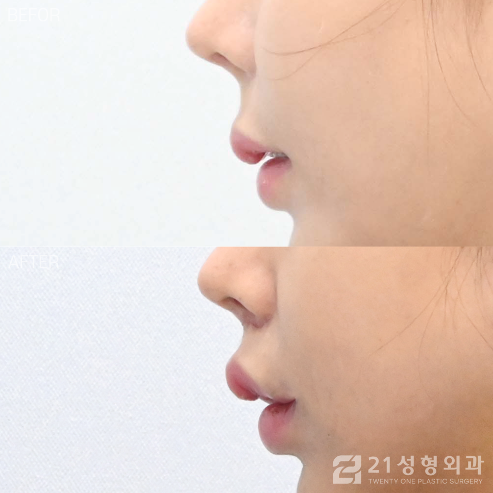 인중축소병원 저렴한 곳만 찾으면 안 되는 이유 관련 이미지 4