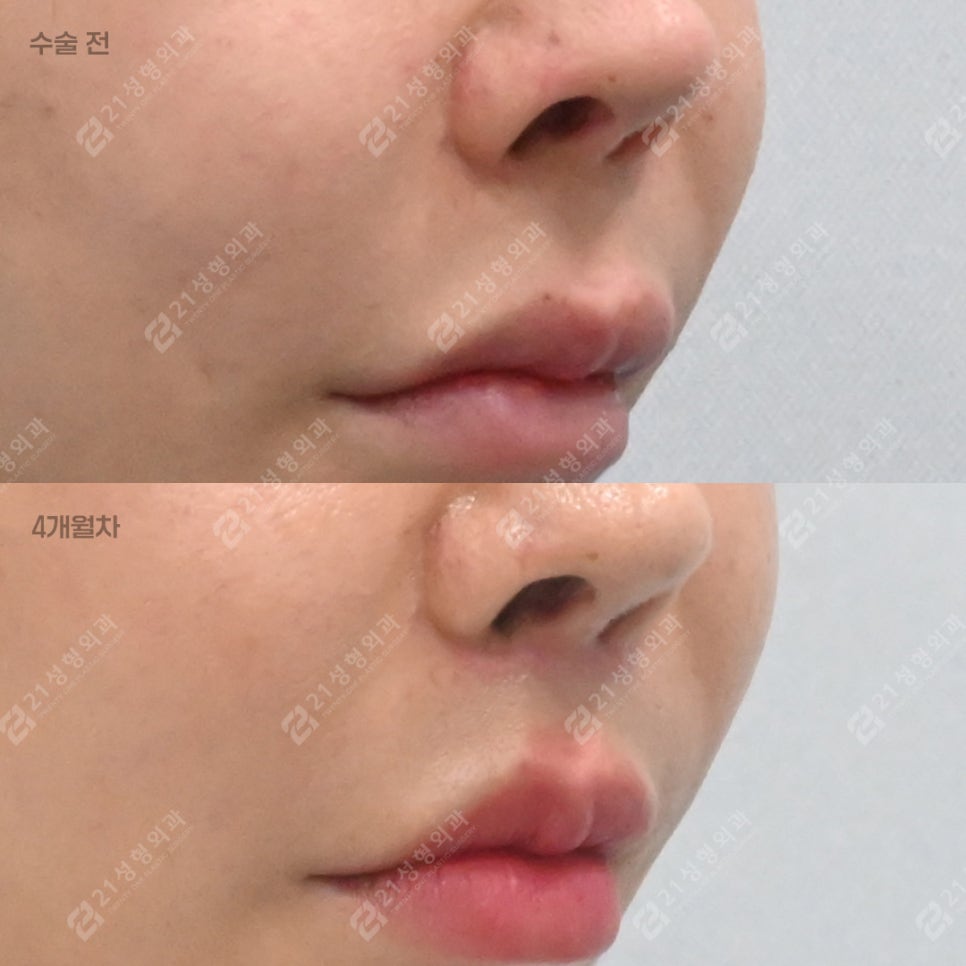Why More People Are Seeking Philtrum Reduction Recently &ndash; 21성형외과 image 4