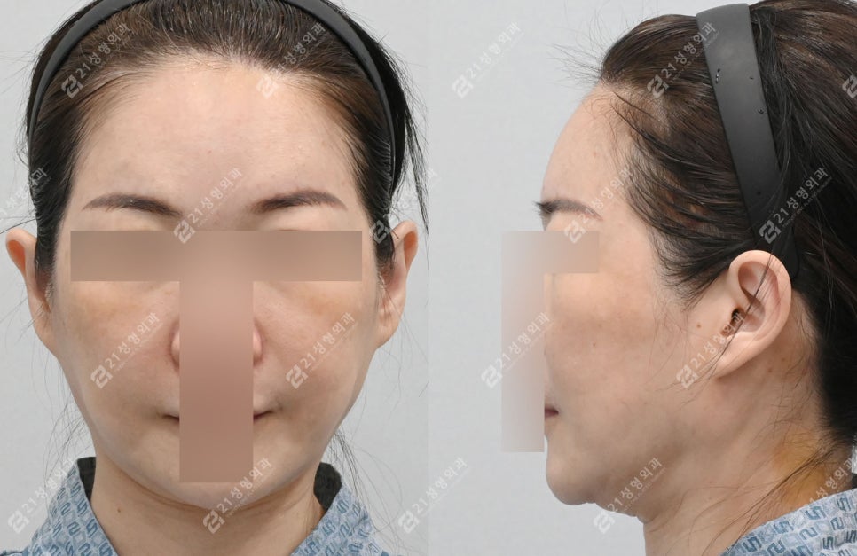 Natural Ear Lines Without Knife-Edge Earlobes: Facelift + Neck Lift Surgery Review image 3