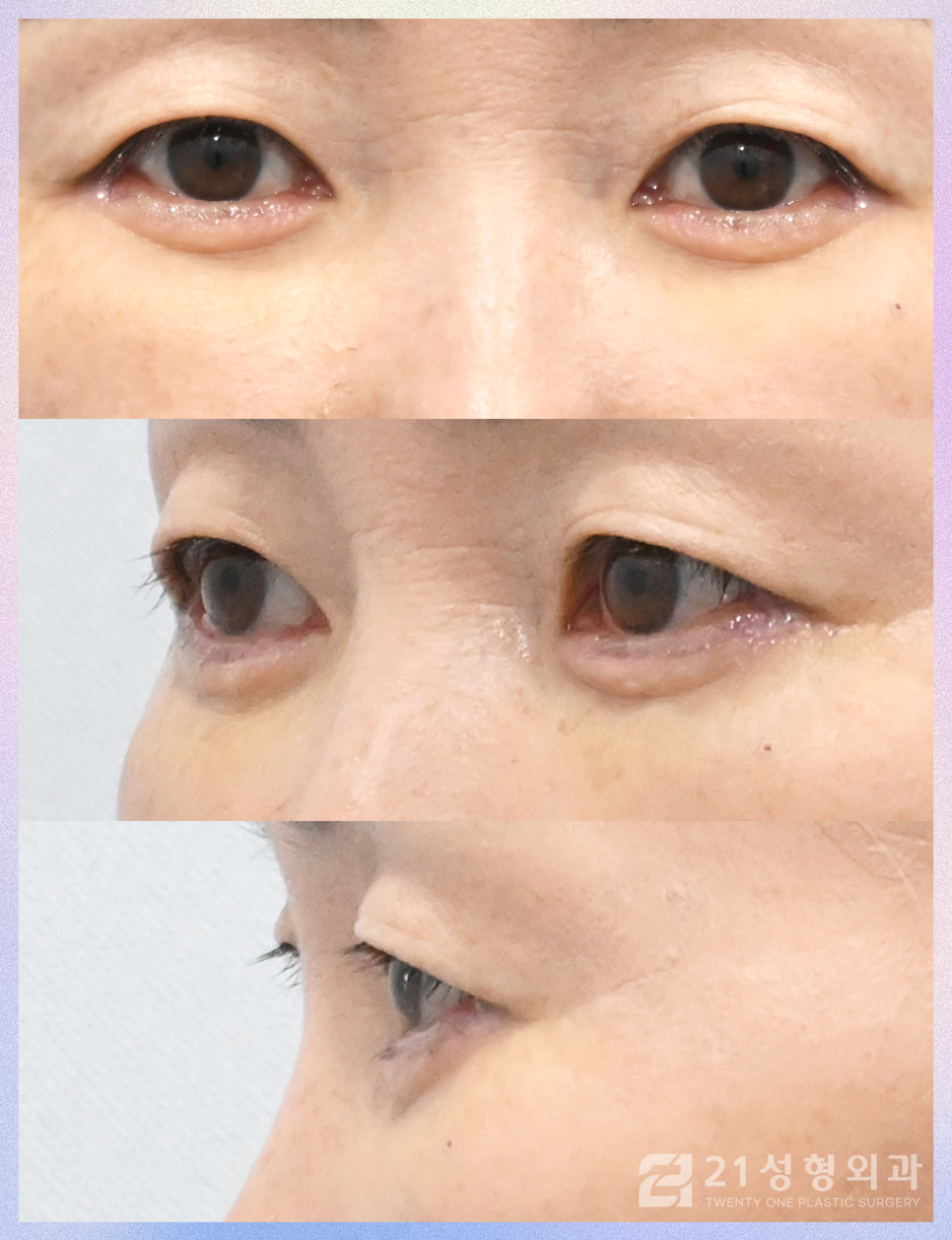 하안검수술후케어 젊음을 유지하기 위해서는 관련 이미지 5