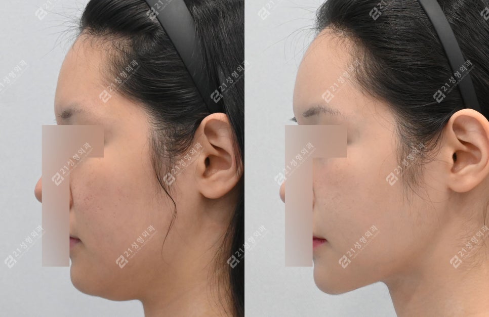 Double Chin Surgery, There Was Actually Another Cause (Real Case Analysis) image 1