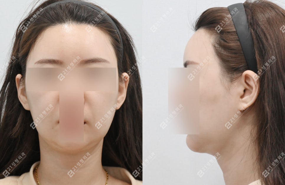 이중턱 수술 후 딱딱함&middot;울퉁불퉁 피부, 괜찮은걸까? 관련 이미지 4