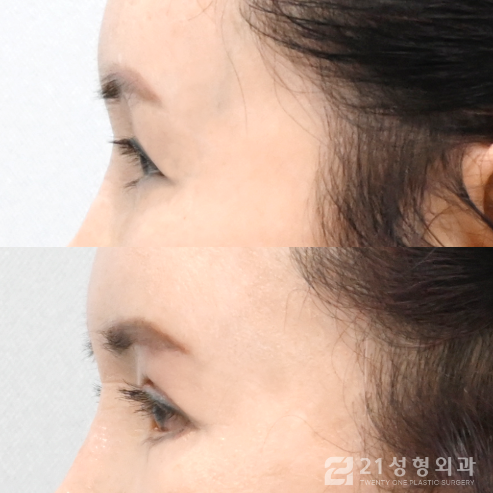 40대쌍수, 근본적인 원인부터 해결하자 관련 이미지 3