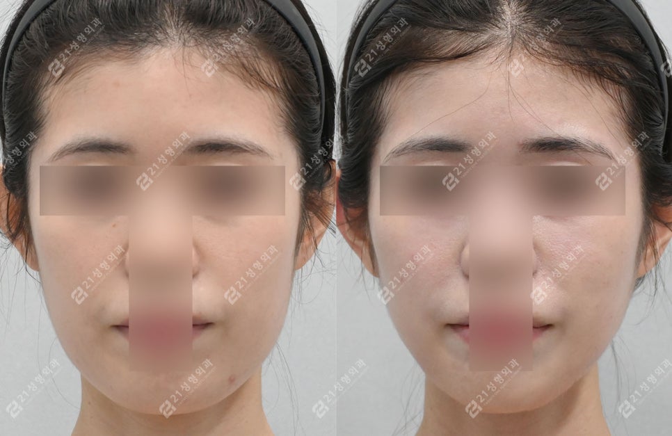 21성형외과에 사연을 들려주세요 두번째 이야기(안면거상/이중턱) 관련 이미지 5
