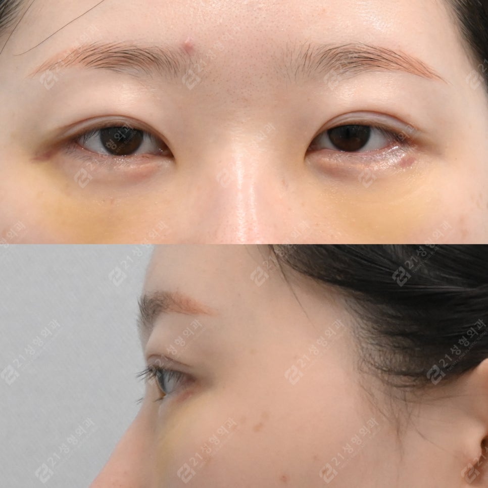 Recovery Period Before and After Lower Eyelid Fat Repositioning image 3
