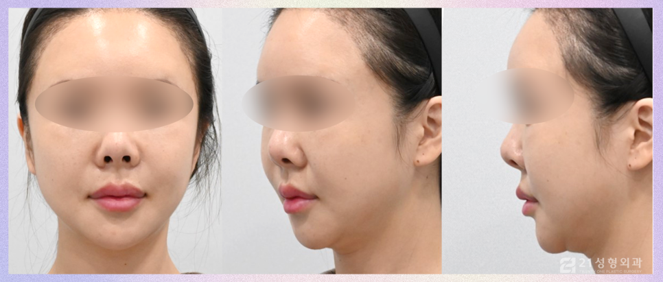코성형잘하는곳 전체적인 비율을 고려해야 관련 이미지 6