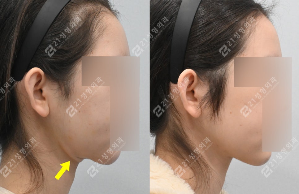이중턱 수술 후 턱밑 피부가 접혔는데 이게 정상이라고요? 관련 이미지 5
