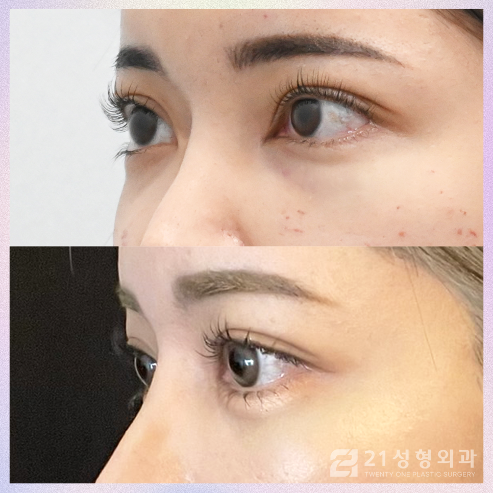 눈밑지방재배치병원 선택 시 고려해야 하는 것 관련 이미지 3