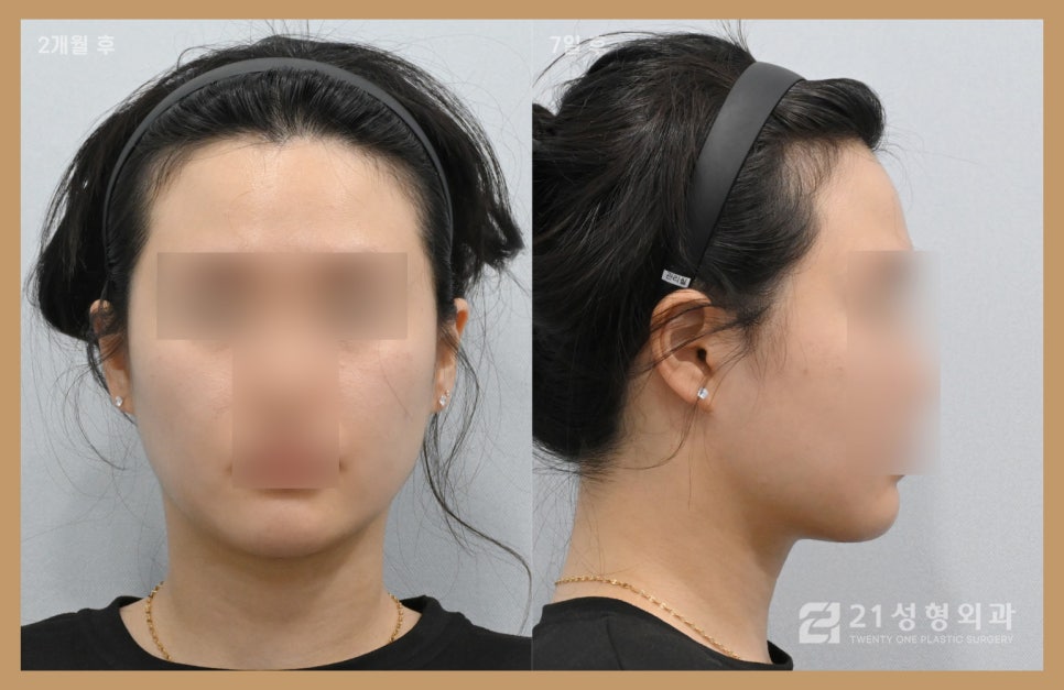 이중턱지방흡입부기 과정이 궁금하다면 관련 이미지 6