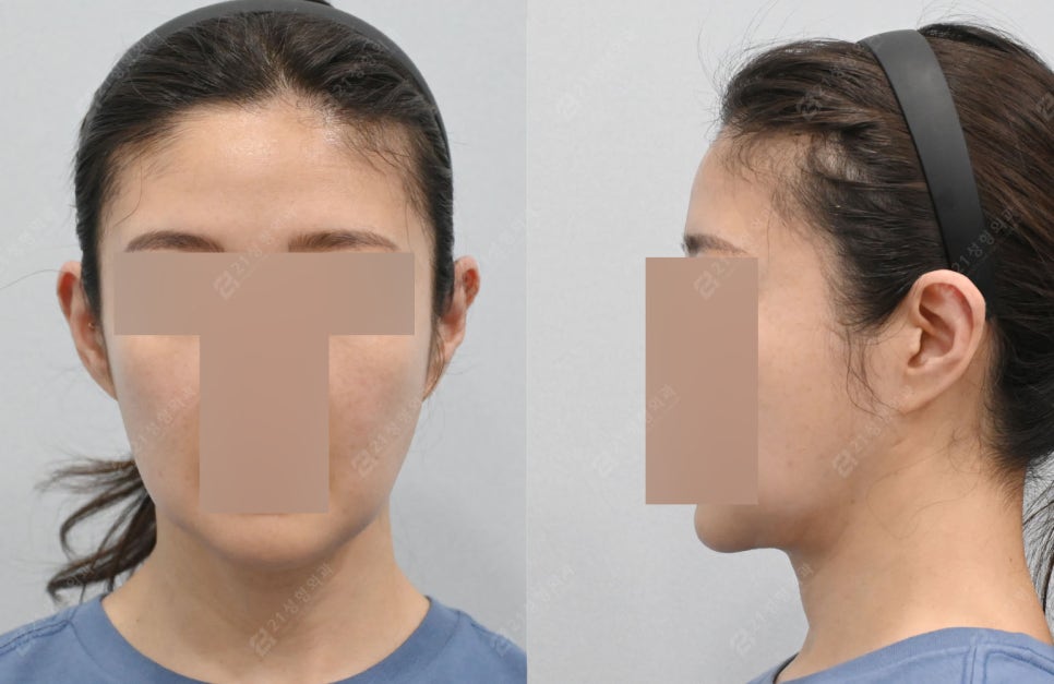 Real Review: A Smooth Improvement of Leftover Double Chin and Jowl Fat Even After Dieting image 5