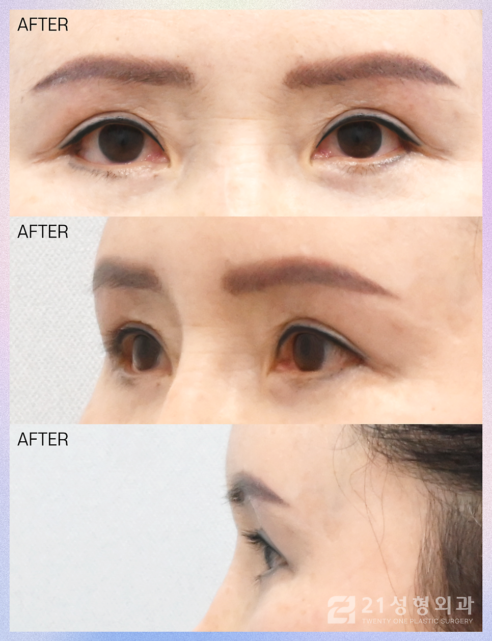 상안검수술흉터 걱정되신다면 관련 이미지 7