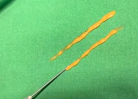 What Is the Secret to Keeping Under-Eye Fat Grafting Beautiful and Natural for a Long Time? image 3