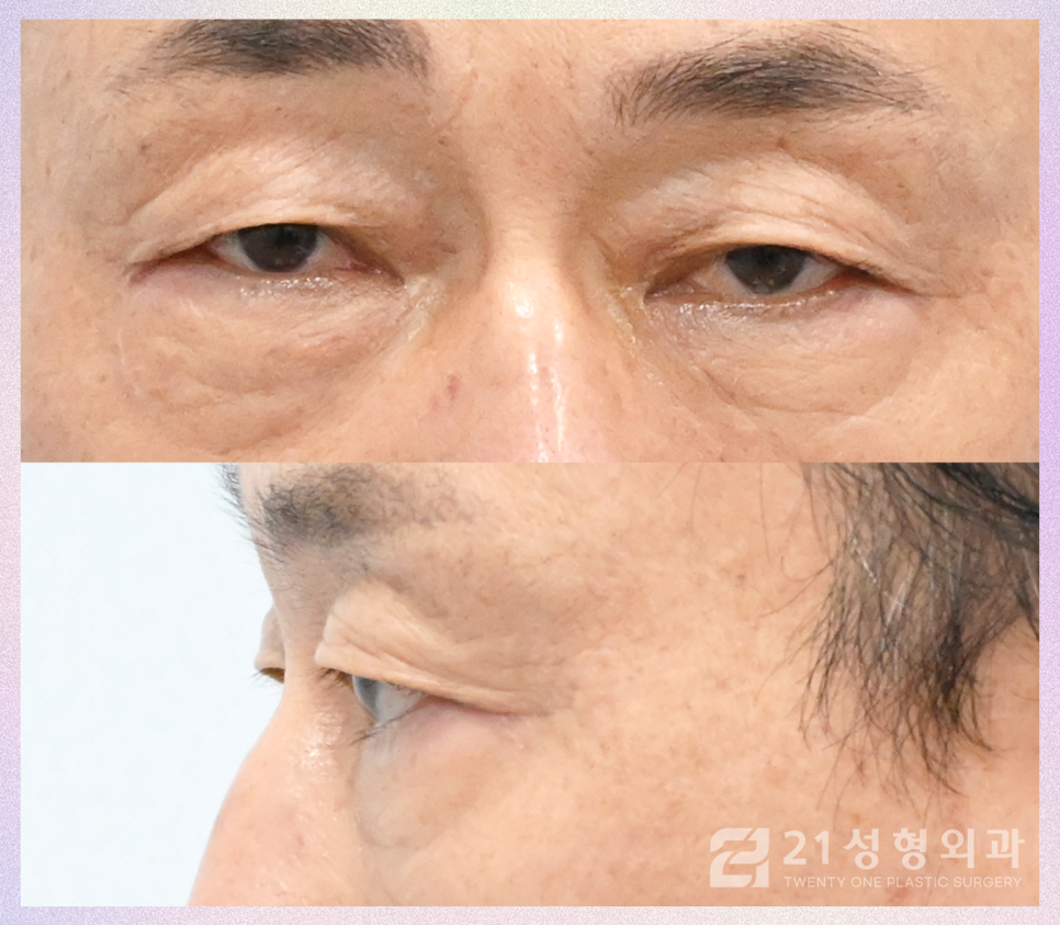 중년눈수술, 젊어지기 위해 필요한 것은 이것입니다 관련 이미지 5
