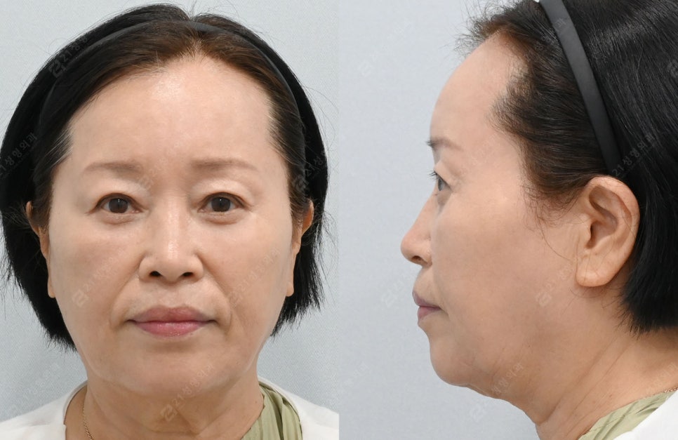 자연스럽게 젊어지고 싶다면? 중년 수술 이마거상, 상.하안검으로 해결! 관련 이미지 5