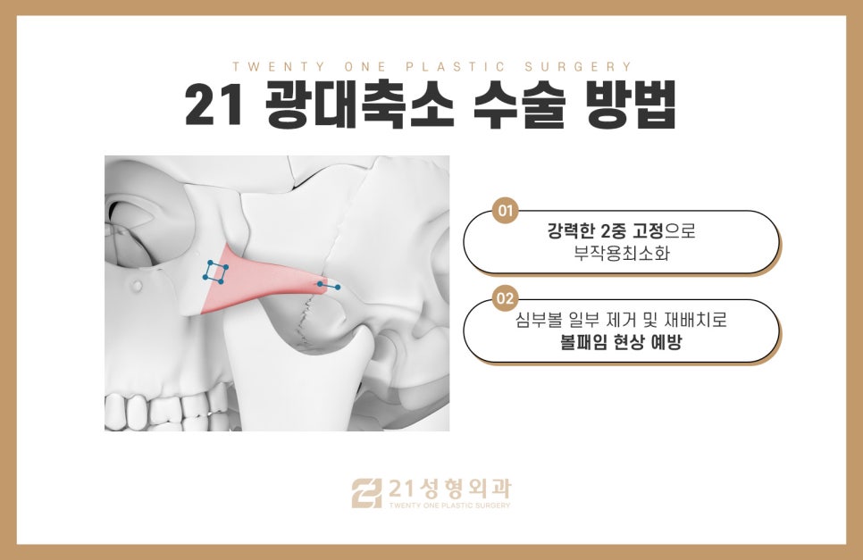 남자광대축소술 울퉁불퉁한 라인을 매끄럽게 관련 이미지 6