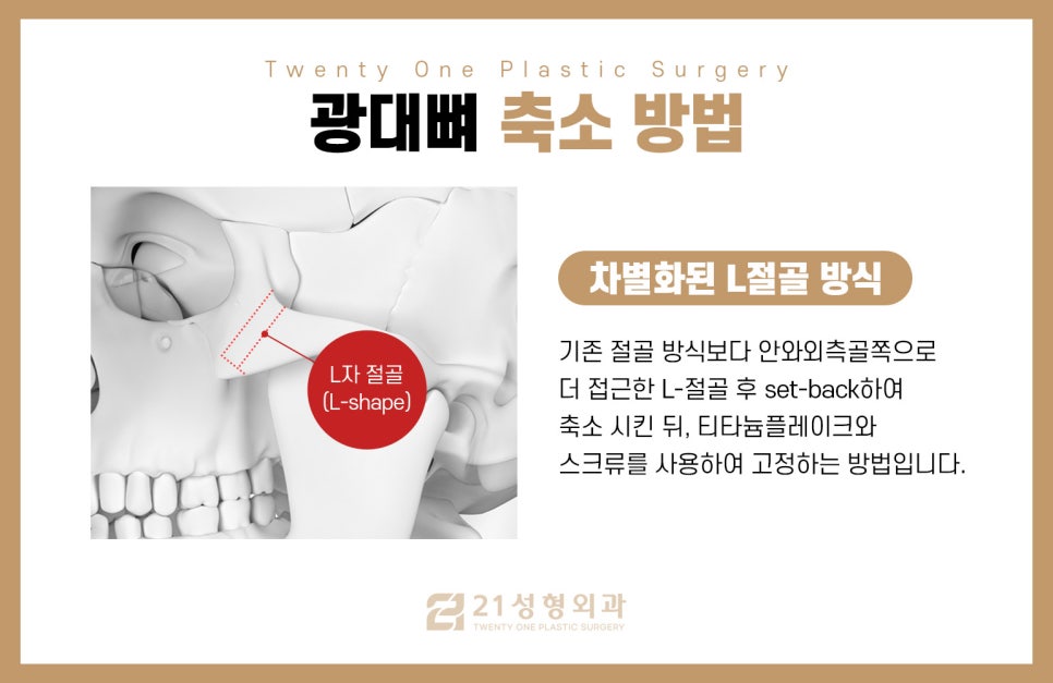 옆광대수술 전 필수로 확인해야 하는 것 관련 이미지 3