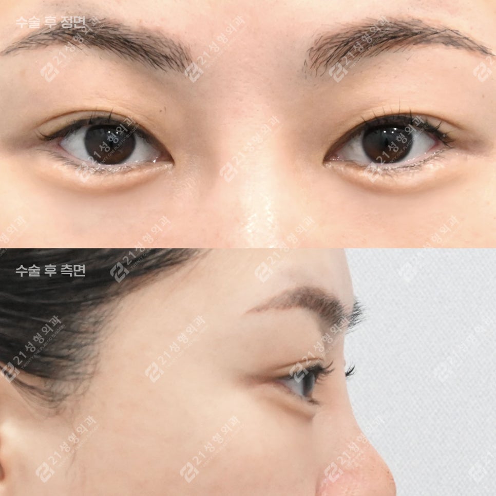Can Tired Eyes Be Changed? A Real Review of Under-Eye Fat Repositioning for a Woman in Her Late 30s! image 3