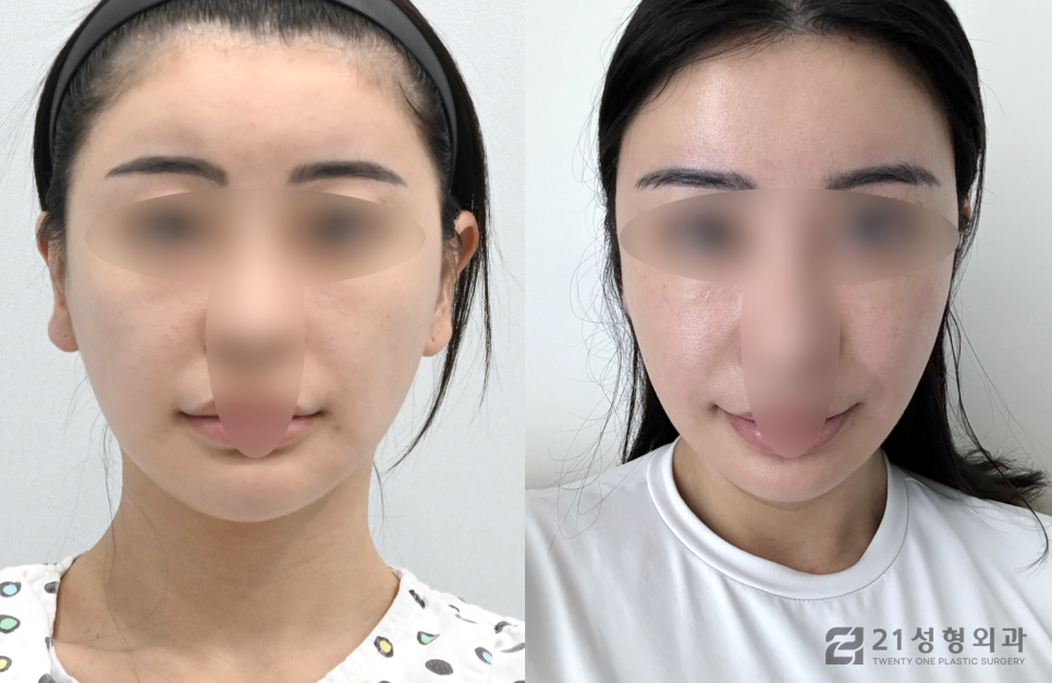 이중턱살제거수술 전 정확히 알아야 할 것 관련 이미지 1