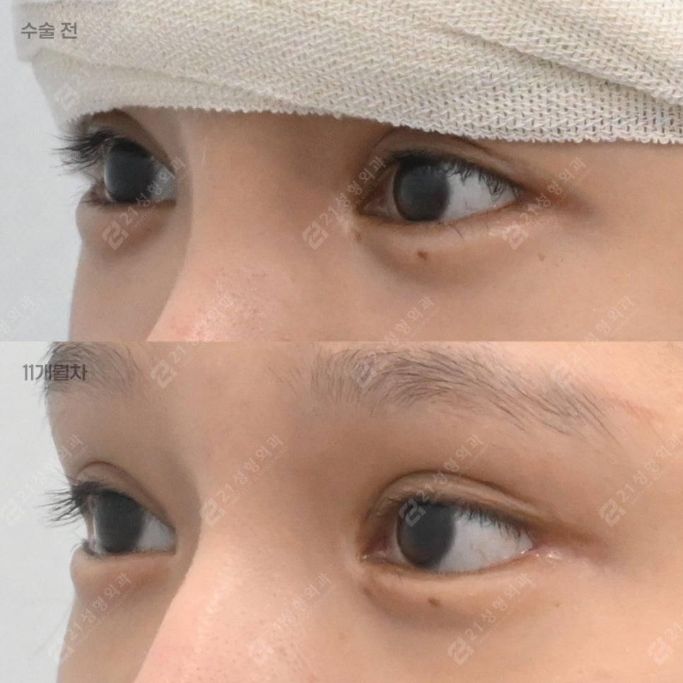 The Golden Time to Correct Failed Eye Corners? Essential Checklist for Lateral & Lower Canthoplasty Revision image 2