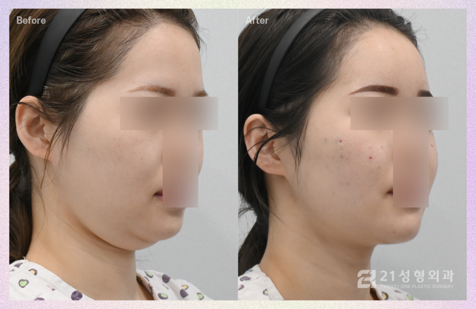 이중턱흡입 후 뚜렷해진 턱 라인 관련 이미지 2