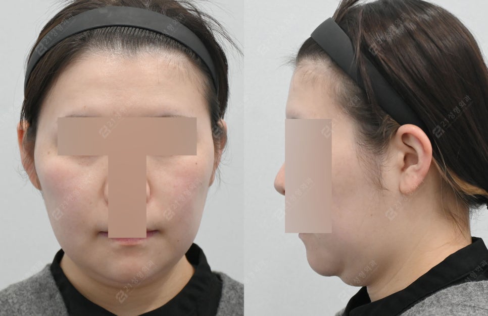 Can I Have a Clean Jawline Too? A Real Review of Double Chin Removal image 2