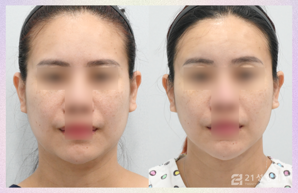 투턱지방흡입 이중턱없는 매끈한 턱 라인이 필요할 때 관련 이미지 1
