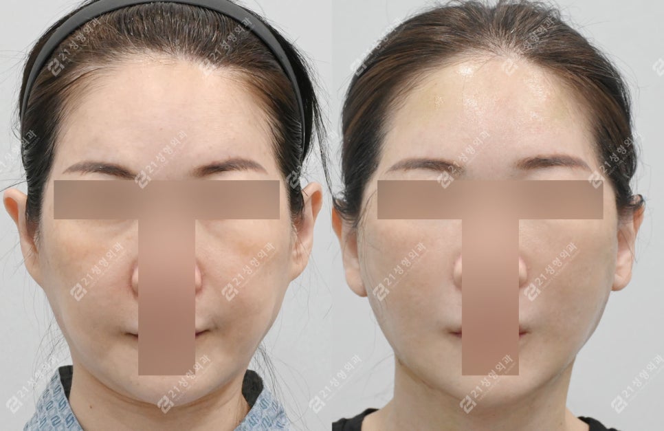 Natural Ear Lines Without Knife-Edge Earlobes: Facelift + Neck Lift Surgery Review image 1