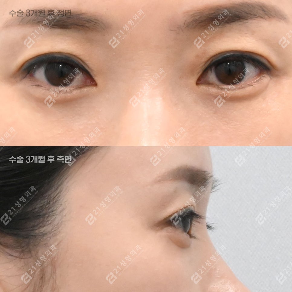피곤해 보이던 40대 눈밑, 하안검 후 이렇게 달라졌습니다 관련 이미지 4