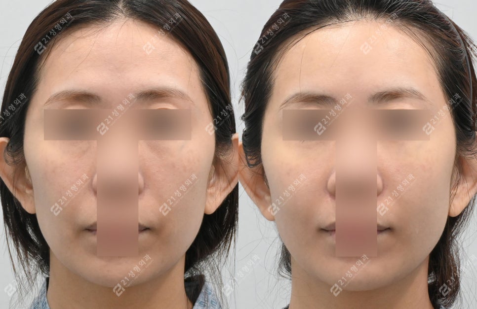 Could a lump you feel after fat grafting be cancer? image 6
