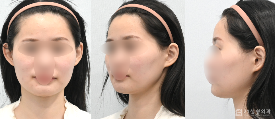 안면윤곽잘하는병원 선택할 때 중요한 점 관련 이미지 4