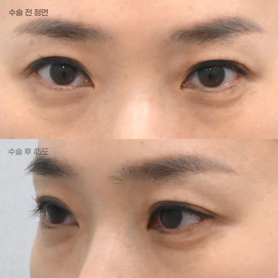 상담할 때 눈밑 피부를 먼저 확인하는 이유 관련 이미지 4