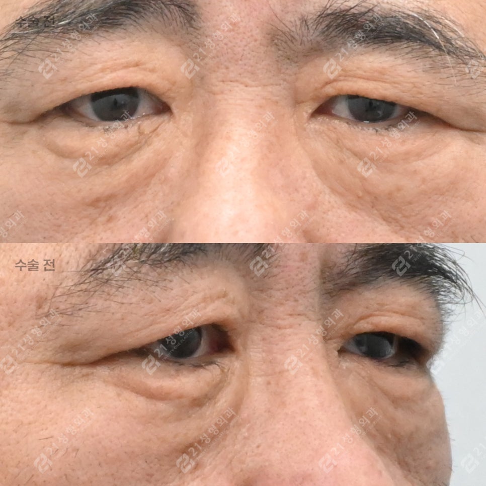 눈밑 처짐으로 인상이 무너지기 전에, 21성형외과 남성 하안검 관련 이미지 5