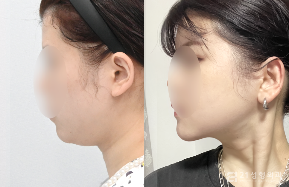 안면윤곽 3종 케이스에 따라 다른 수술과정 관련 이미지 3