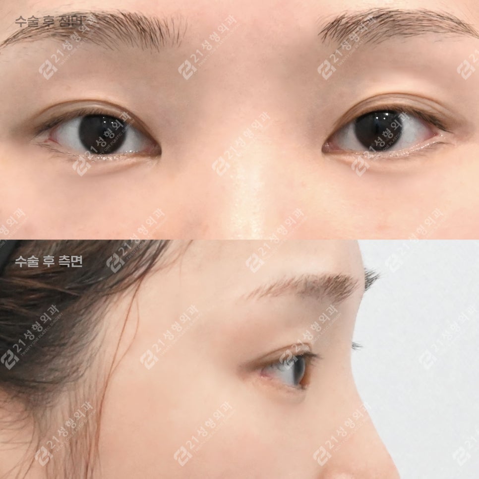 Dark Circles, Caused by Lack of Sleep? Lower Eyelid Fat May Be the Reason! image 3