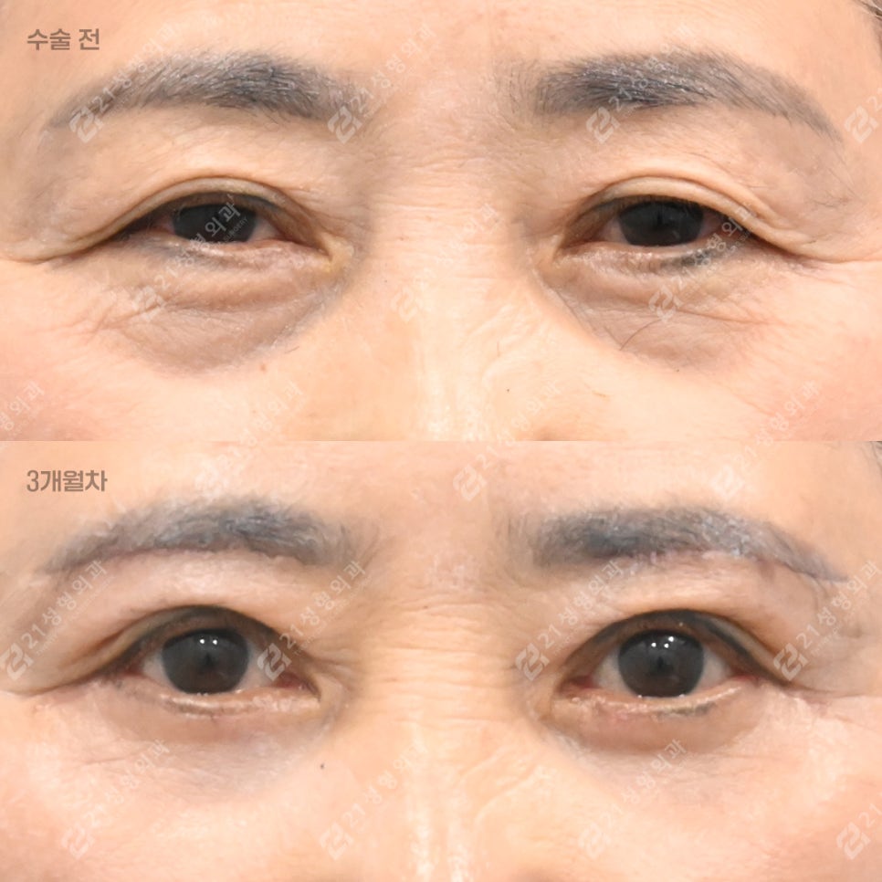 If You Keep Tensing Your Forehead, Consider Eyelid Drooping image 1