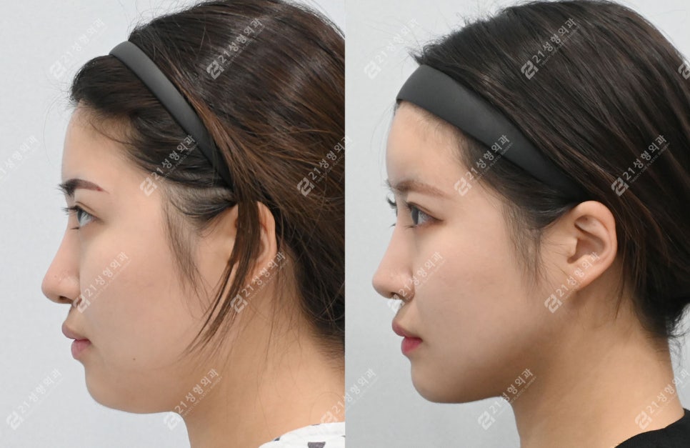 Real Review of Square Jaw Surgery: Square Jaw Surgery Is Not Over After Just Shaving the Bone image 10