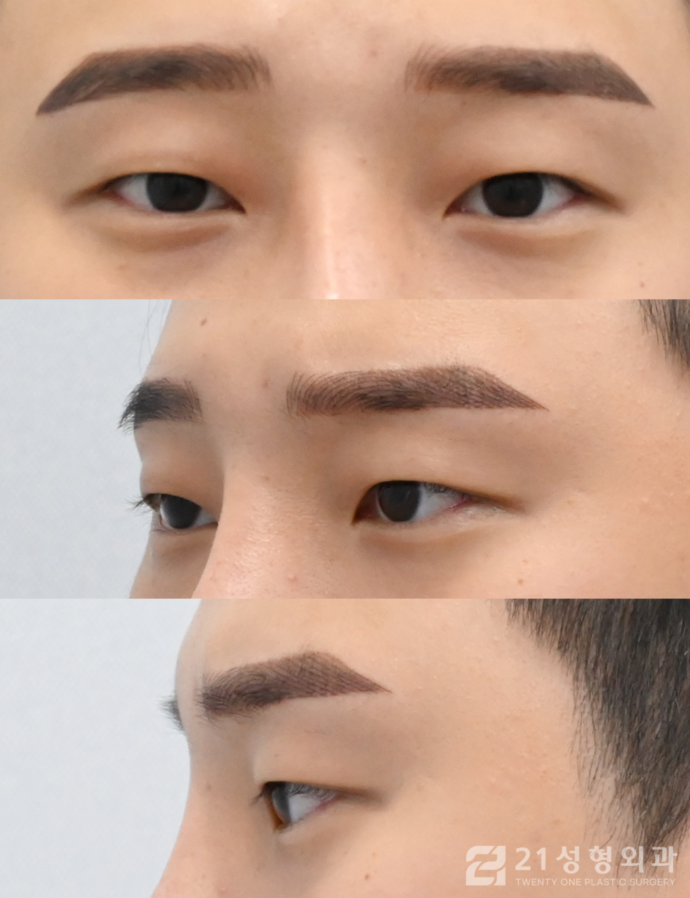 첫눈성형잘하는곳 아름다워지는 지름길 관련 이미지 4