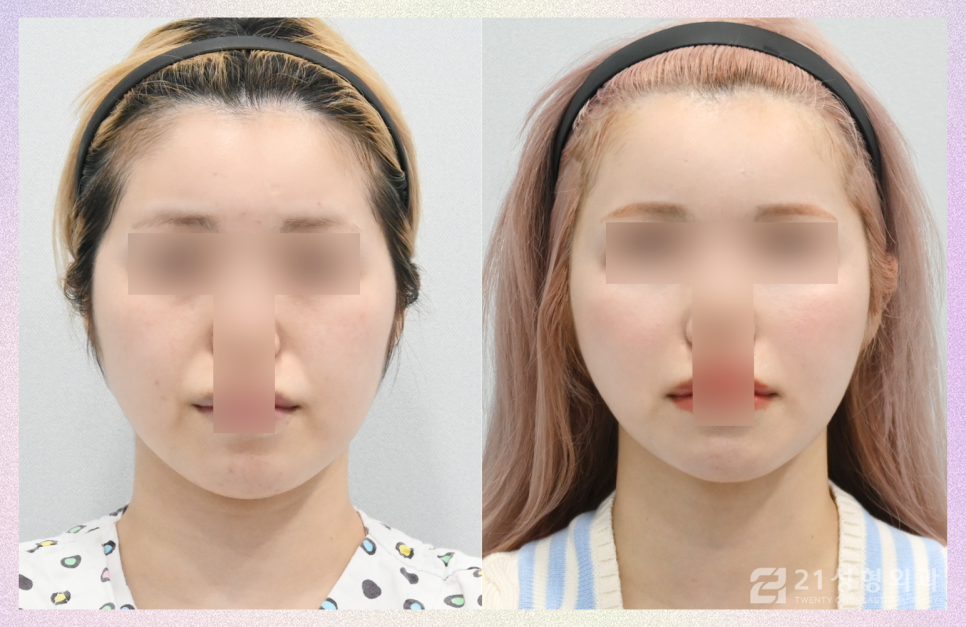 얼굴지방이식잘하는곳 노하우가 궁금하다면 관련 이미지 1